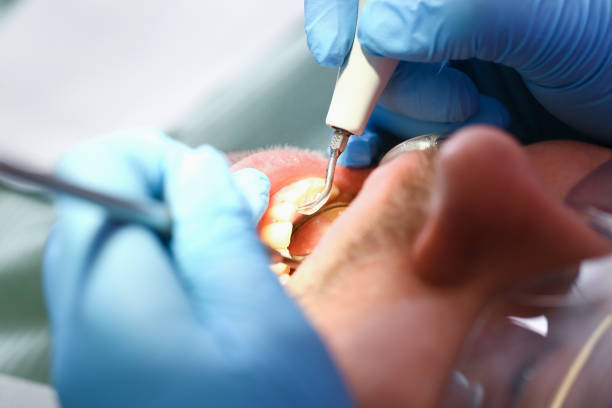 Best Dentist for Tooth Abscess  in Nicollet, MN